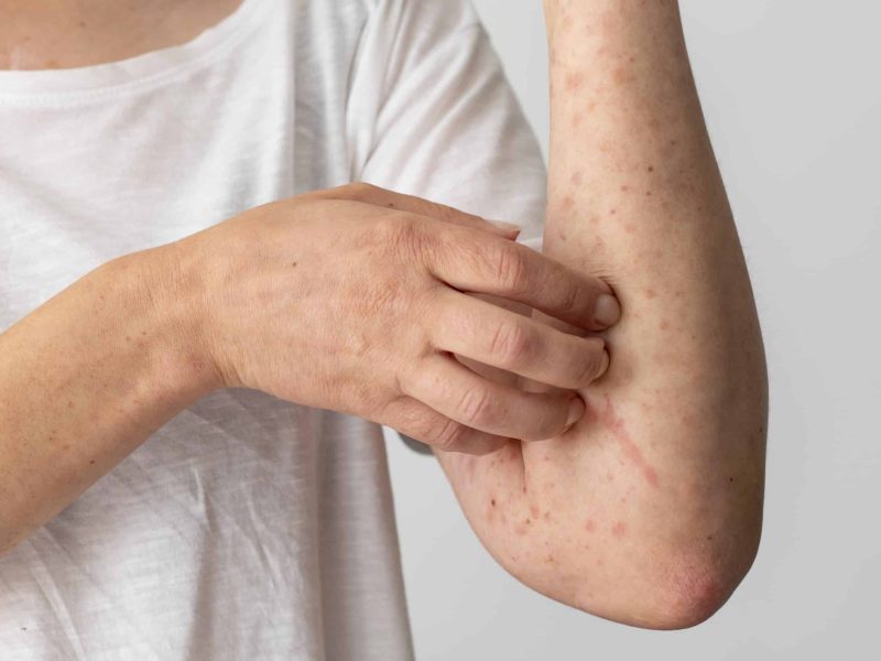 skin-allergy-reaction-person-s-arm (1)